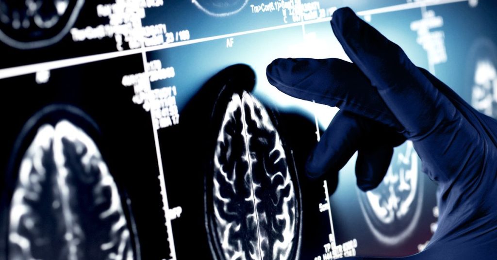What One Man's 'Escape' from Alzheimer's Might Tell Us About The Disease