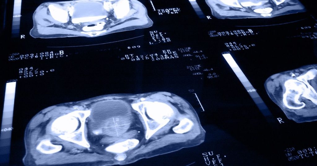 Going to screenings May Lower Death Risk from Prostate Cancer by 23%