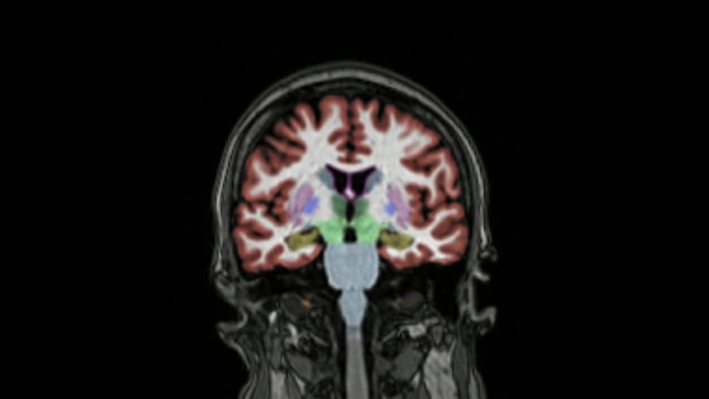 Arriva anche in Europa il primo farmaco contro l’Alzheimer