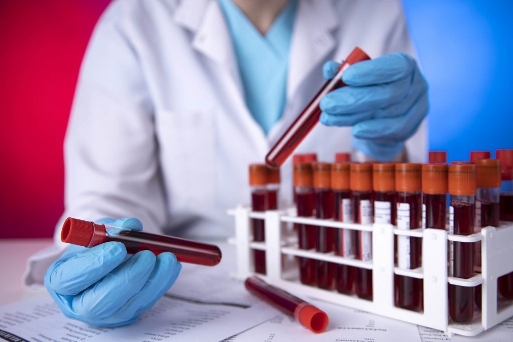 Alzheimer, la diagnosi precoce ora si fa con un test del sangue