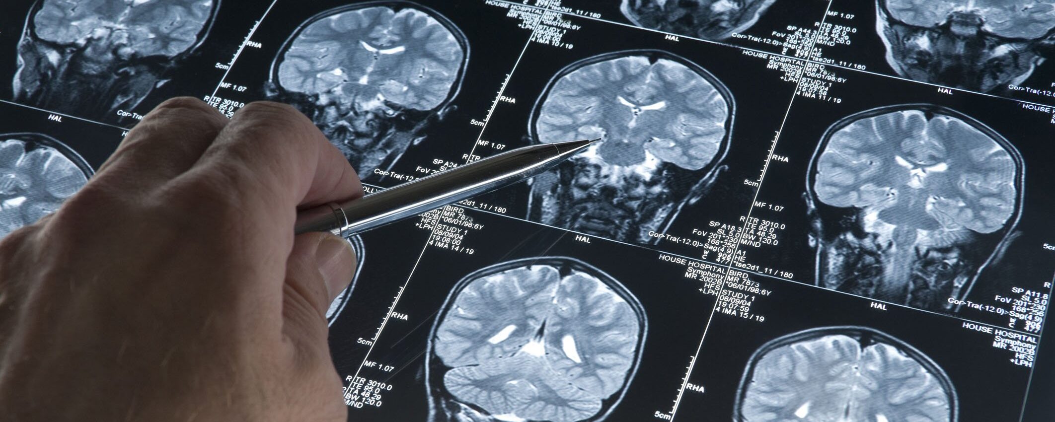 Il più piccolo neurostimolatore al mondo che rivoluziona la cura del Parkinson