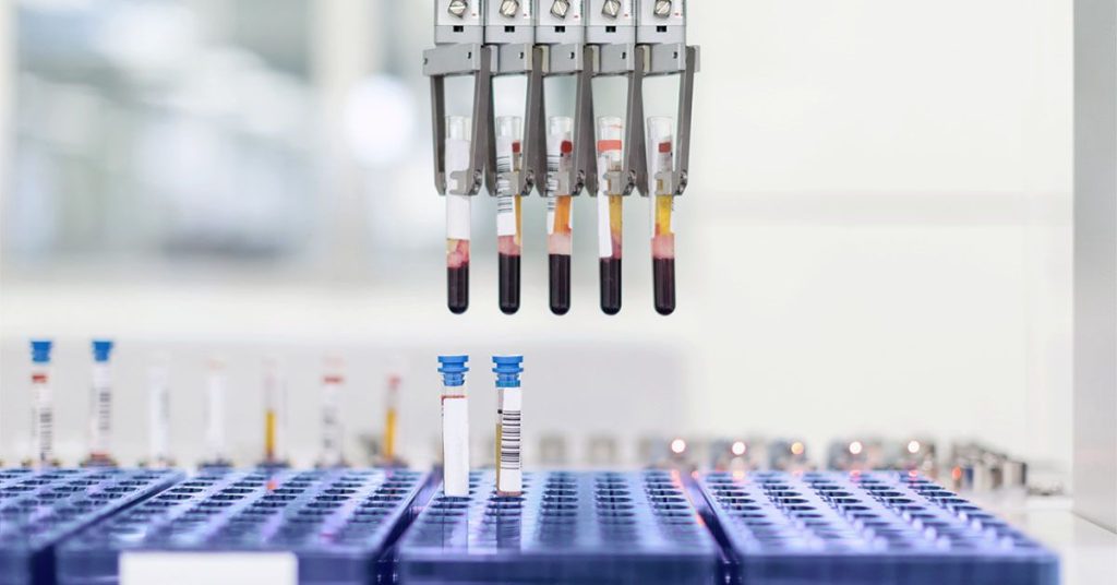 Insulin Resistance Test May Help Predict Early Alzheimer's Cognitive Decline Rate