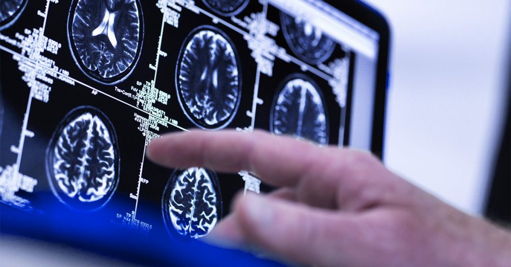 Could a Single Brain Scan Predict The Risk of Age-Related Conditions Like Dementia?