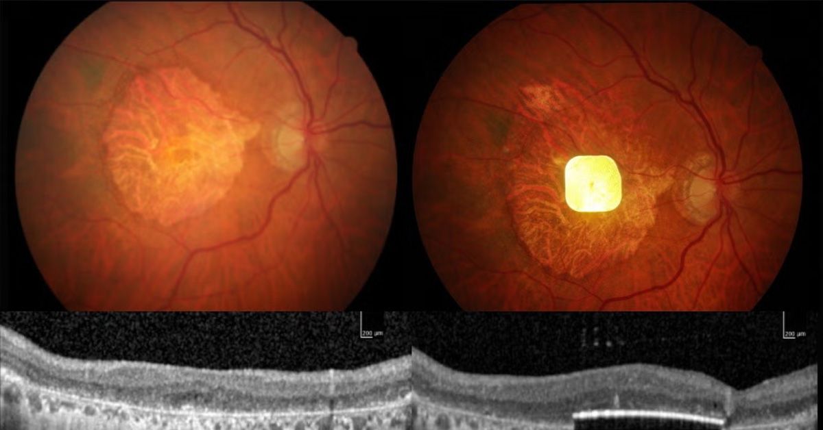 New retinal implant may restore central vision in people with advanced AMD