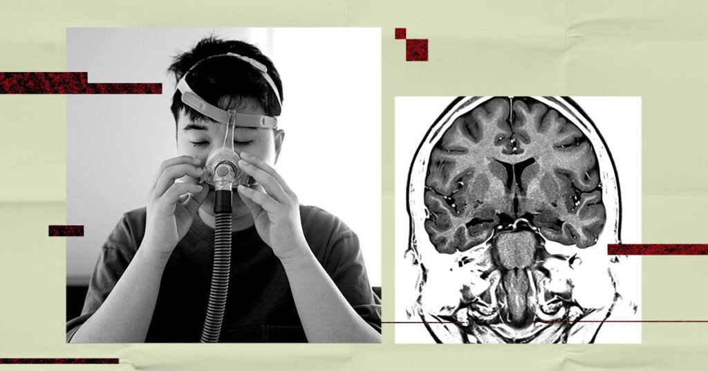 Sleep apnea may raise microbleed risk in brain, lead to dementia or stroke