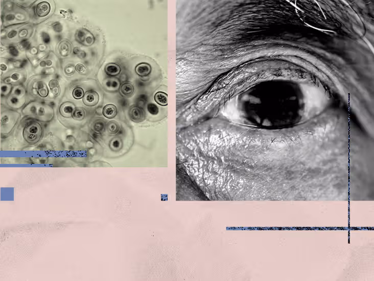 Could this common bacteria in the eye be driving Alzheimer's disease?