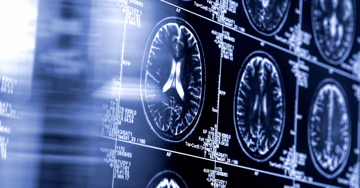 AI-powered stroke tool linked to improved patient outcomes in large clinical trial
