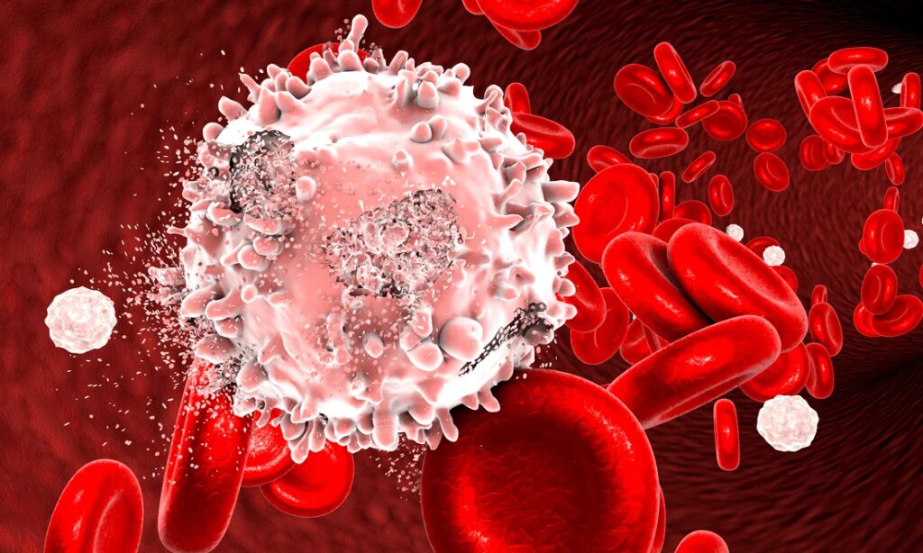 Leucemia linfoblastica acuta: nuove speranze di cura da Padova