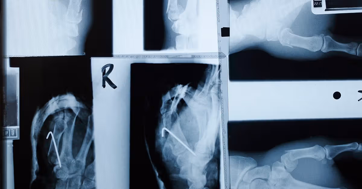 GLP-1s may aid bone health as well as weight loss in type 2 diabetes