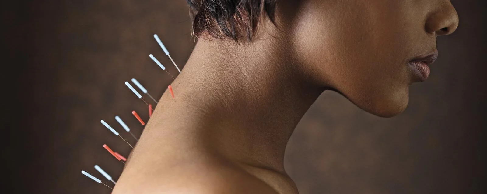 Salute in punta di ago: ecco perché l’agopuntura non è più una medicina alternativa