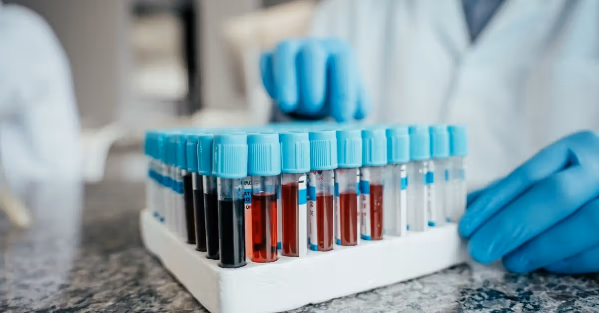 Alzheimer's blood test could identify risk up to 10 years before symptoms start
